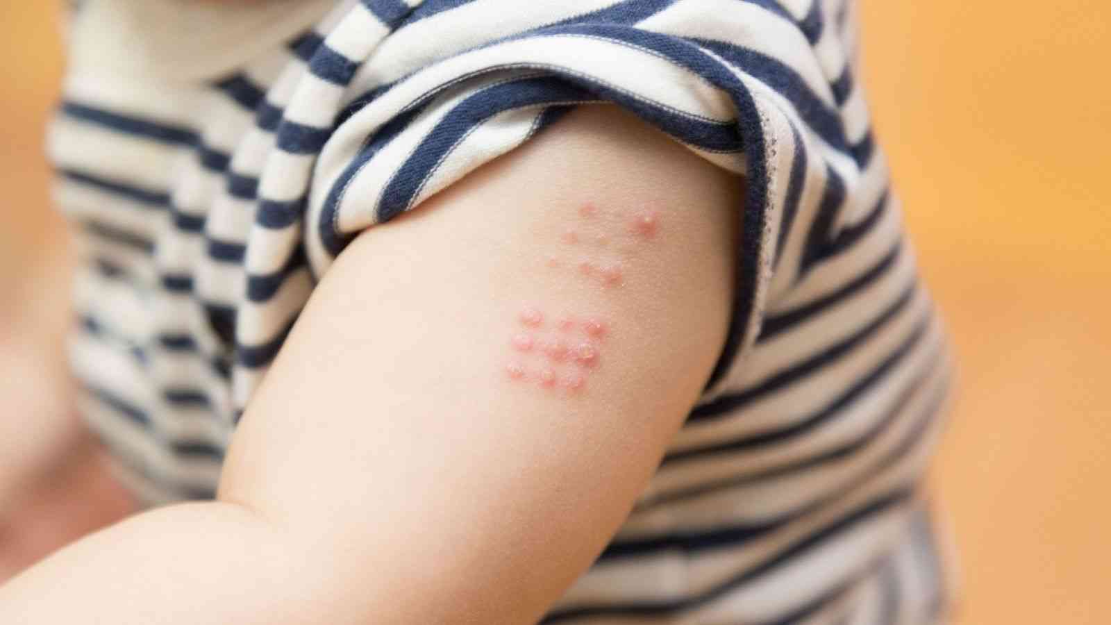 ｢BCG有効説｣眉唾だが懸けてみる価値アリの訳 | コロナショックの大波紋 | 東洋経済オンライン | 経済ニュースの新基準
