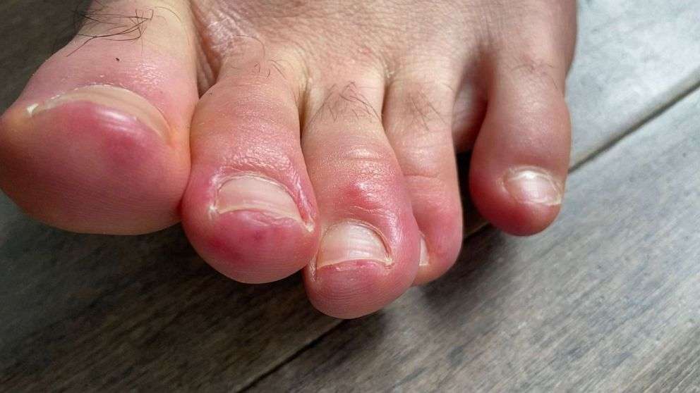 'COVID Toes': Could skin conditions offer coronavirus clues? - ABC News
