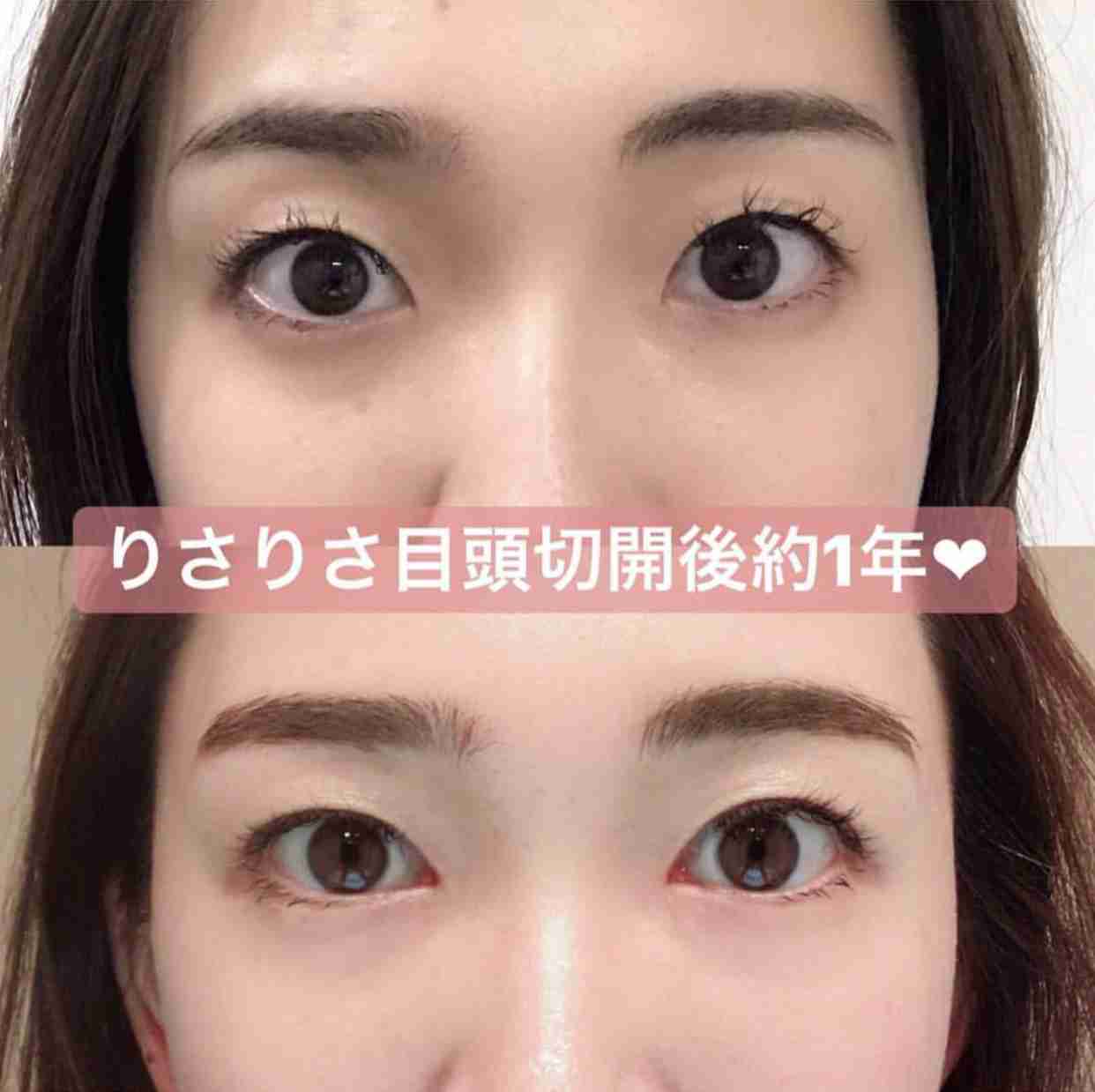 蒙古襞について語るトピ