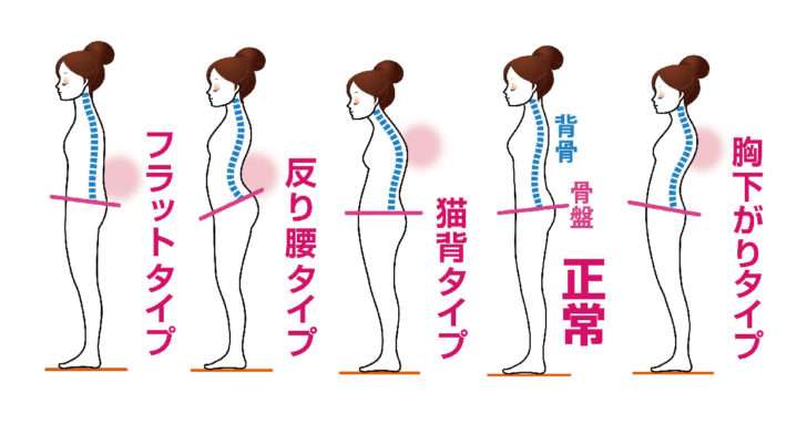 反り腰改善方法