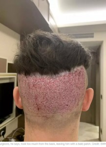 【閲覧注意！】トルコで格安植毛をした26歳男性　禿げと傷痕が痛々しい残念な結果に（英）