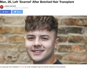 【閲覧注意！】トルコで格安植毛をした26歳男性　禿げと傷痕が痛々しい残念な結果に（英）