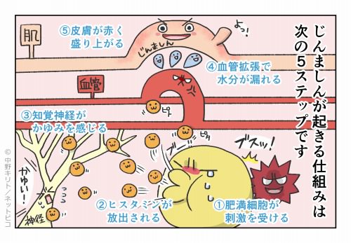 毎日蕁麻疹が出ます