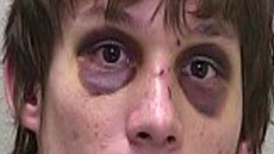 パンダの目（black eyes）は何故起こるか - つねぴーblog＠内科専攻医