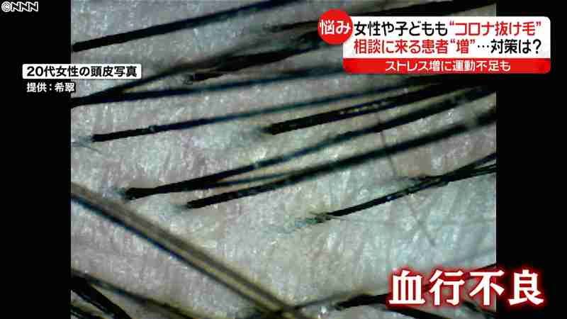 ストレス“コロナ抜け毛”増　女性や子供も｜日テレNEWS24