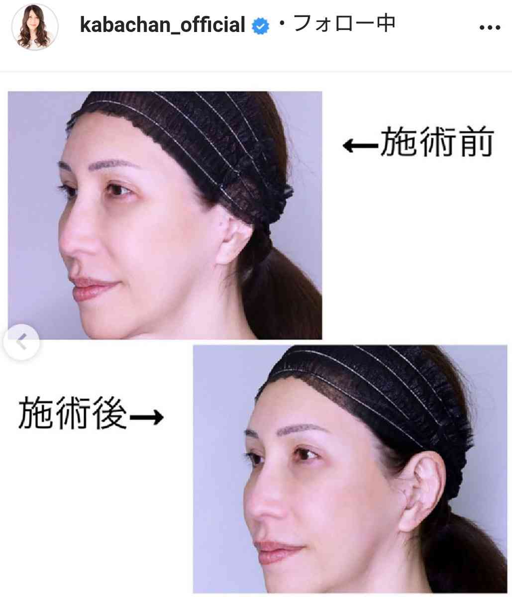 KABA.ちゃん、美容施術を受けビフォーアフター公開「ますます女子力アップで綺麗」「お肌ツルツル！」などの声