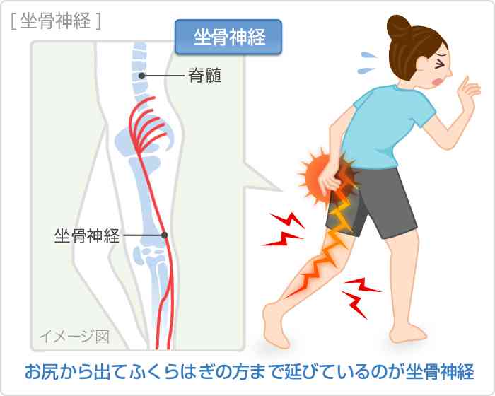 坐骨神経痛の方