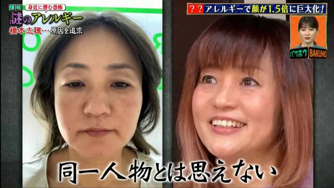 橋本志穂　アレルギーで顔が肥大化…原因はまつエクだった