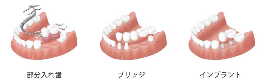差し歯、ブリッジ違い