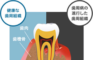 認知症の原因物質　歯周病によって蓄積する仕組みを解明