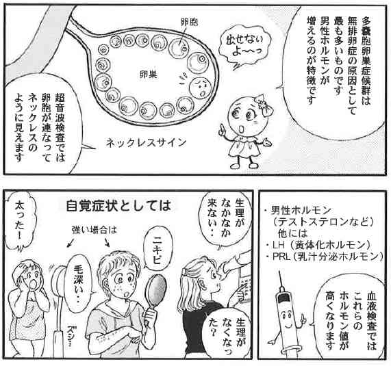 多嚢胞卵巣症候群の症状