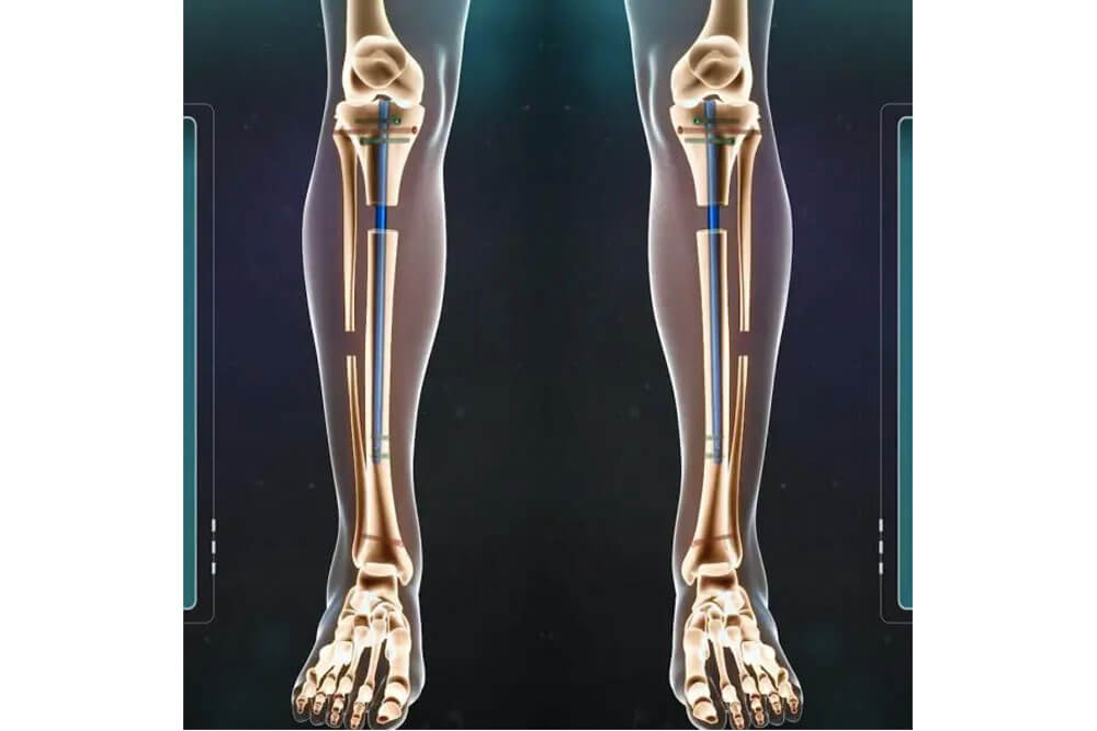 800万円で背を伸ばす手術。「15センチ高くなる」に予約殺到