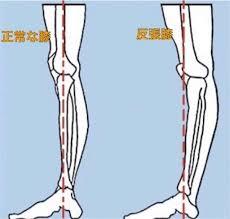 反張膝 | 沖縄県那覇市首里汀良町 スマイル鍼灸整骨院