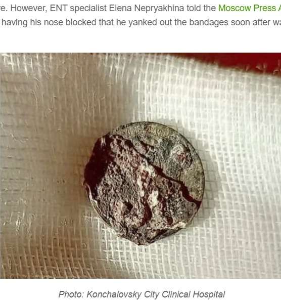 6歳の時に鼻に突っ込んだまま忘れてしまった硬貨、53年後に摘出される（露）