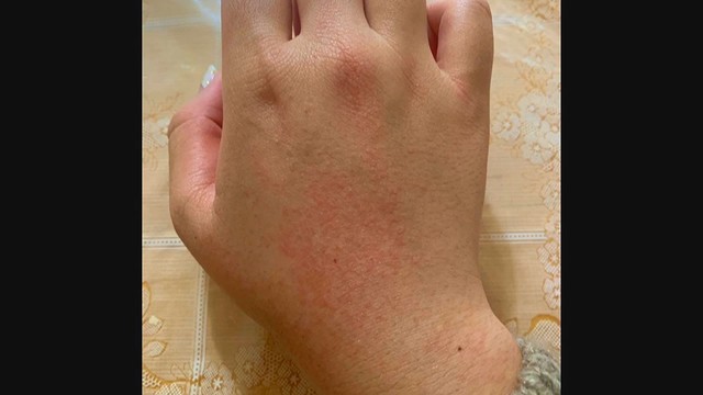 スターバックスで消毒液の詰め替えミス 女性が両手をやけど ガールズちゃんねる Girls Channel