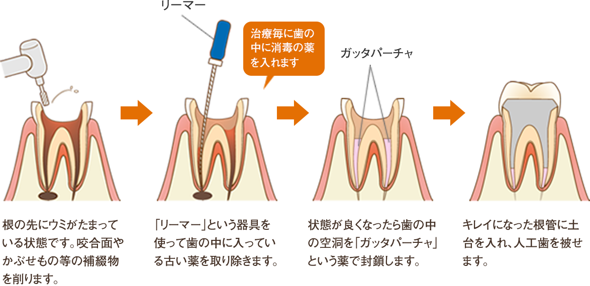 【歯医者】根管治療（神経抜く）してる人