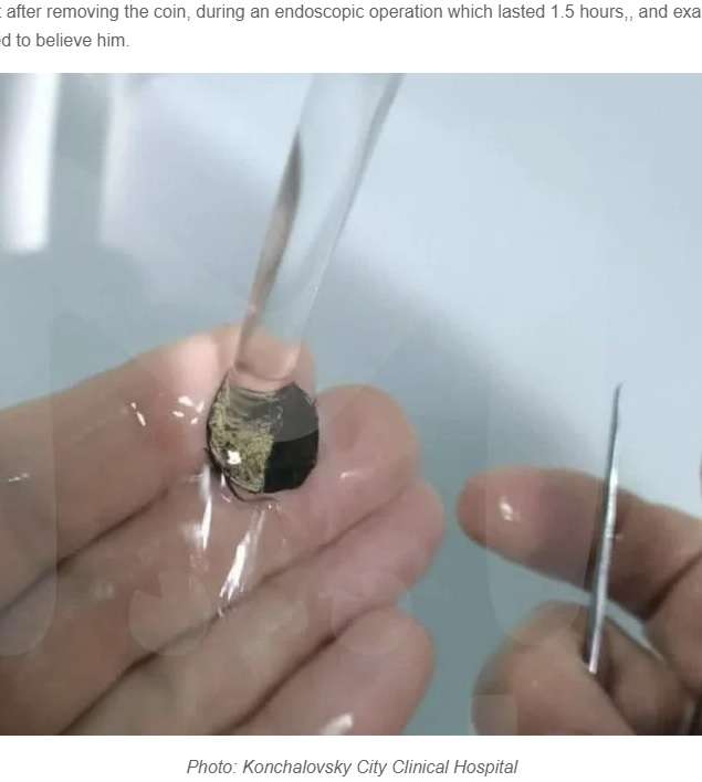 【海外発！Breaking News】6歳の時に鼻に突っ込んだまま忘れてしまった硬貨、53年後に摘出される（露） | Techinsight（テックインサイト）|海外セレブ、国内エンタメのオンリーワンをお届けするニュースサイト
