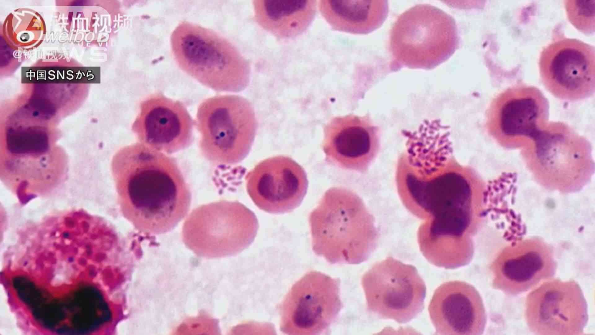 中国でブルセラ症菌漏洩　ずさん管理、3000人が感染