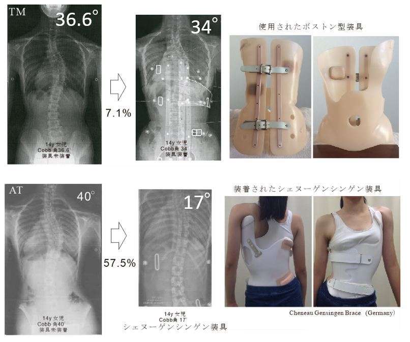 側弯症（そくわん症）の人〜！