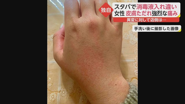 スターバックスで消毒液の詰め替えミス 女性が両手をやけど