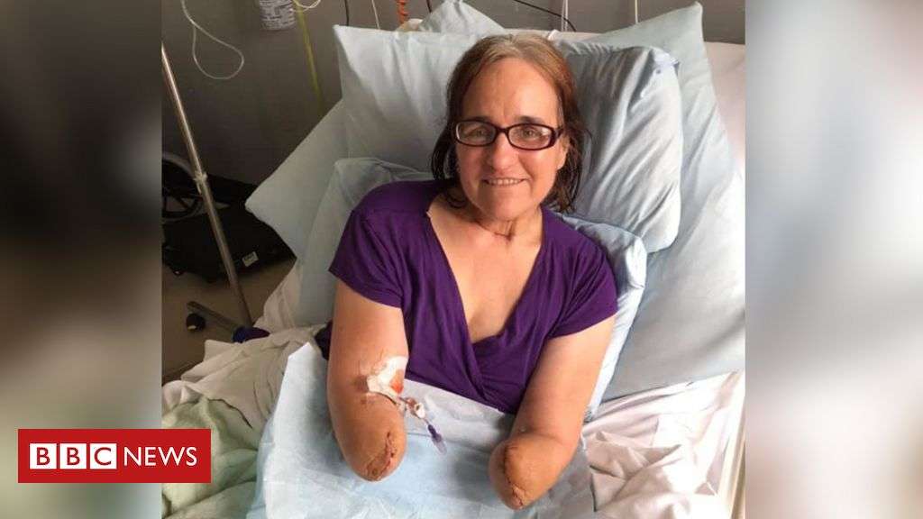 Sepsis: Amputation 'will not change woman' who beat coronavirus - BBC News
