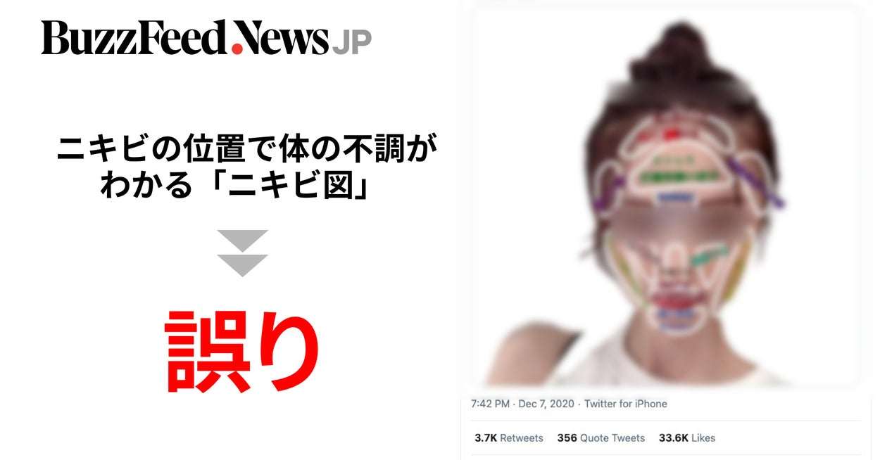 「ニキビの位置で体の不調がわかる」と図が拡散。専門医「全くの都市伝説」