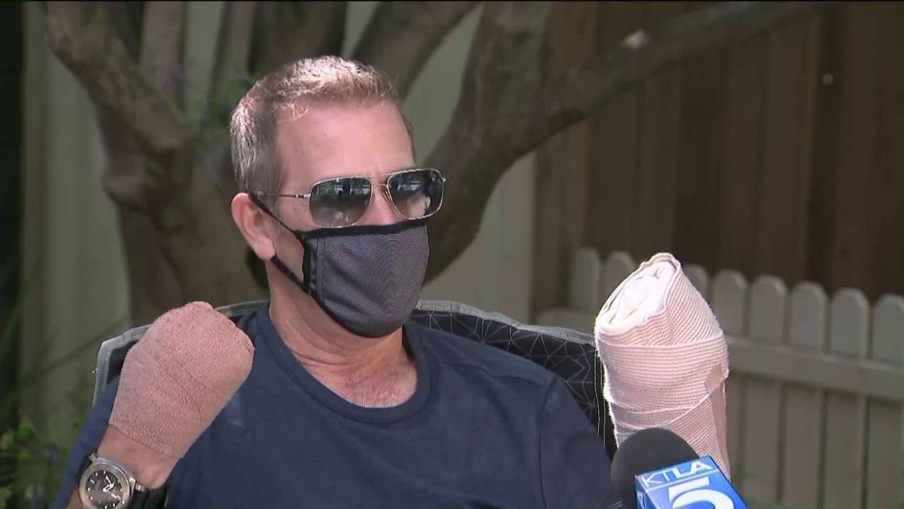 COVID-19 survivor who spent 64 days in Burbank hospital, had most of his fingers amputated: ‘This can happen to you’ | KTLA