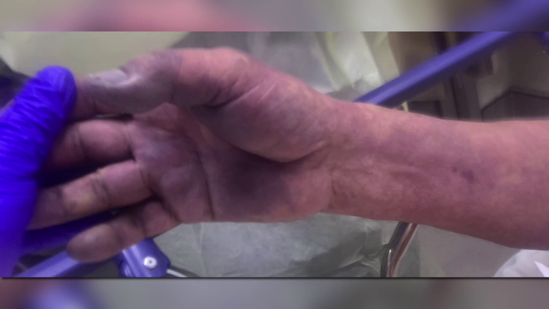 Blood clots a potential symptom of COVID-19, even without other ailments