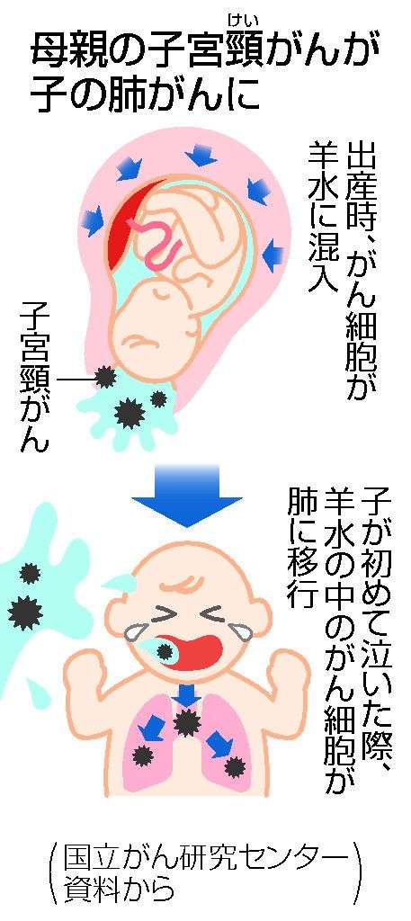 母の子宮頸がん、子に移行　羊水に混入、肺がんに―世界初・国立がん研究センター：時事ドットコム