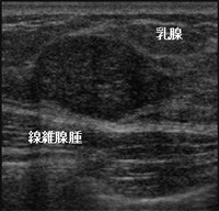 乳腺線維腺腫の方お話しましょう