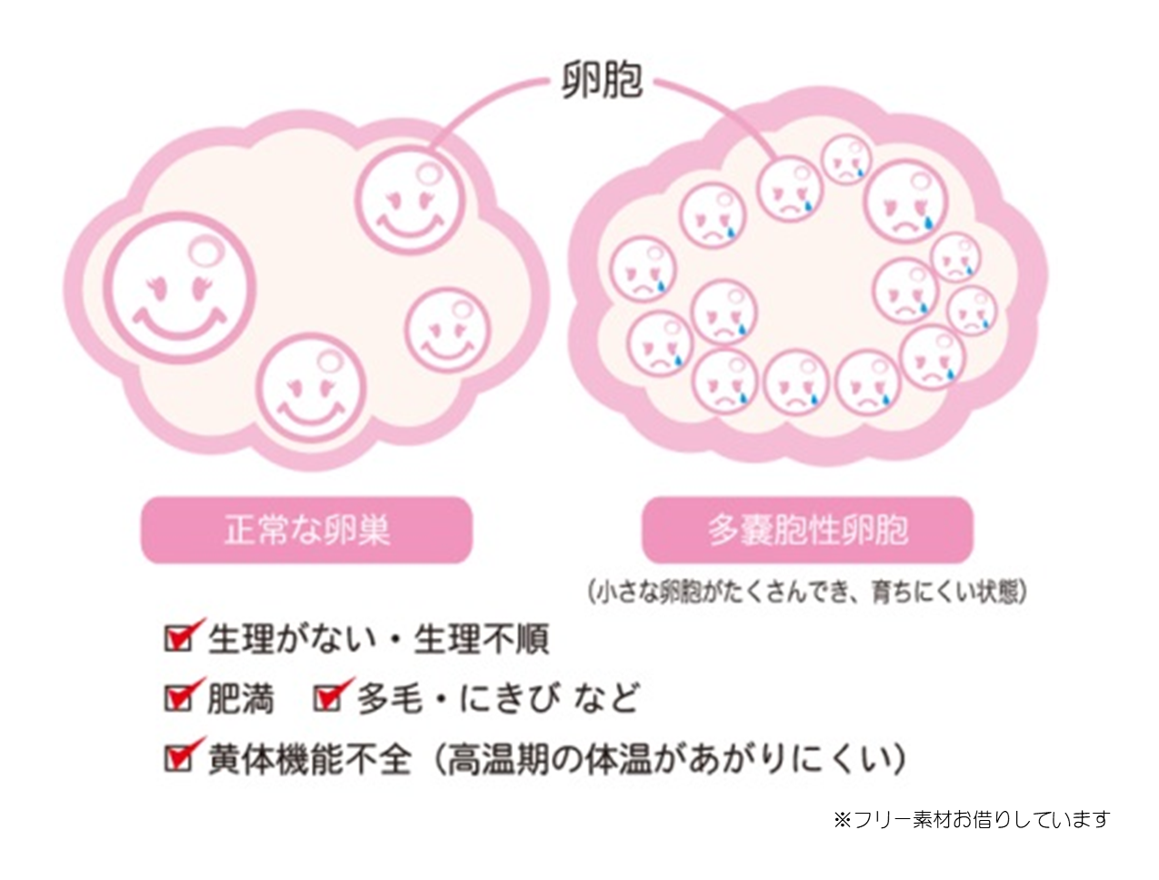 多嚢胞性卵巣症候群で妊娠した方！