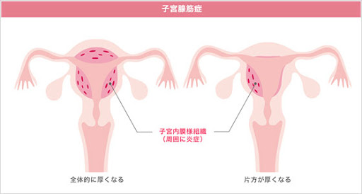 子宮腺筋症の方お話ししましょう