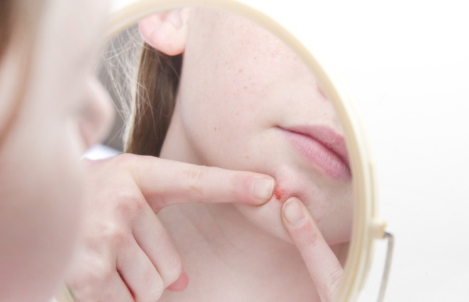 ニキビに悩んだ人の方が肌が老化しにくい　1205組の双子調査で見えてきたこと｜ウートピ
