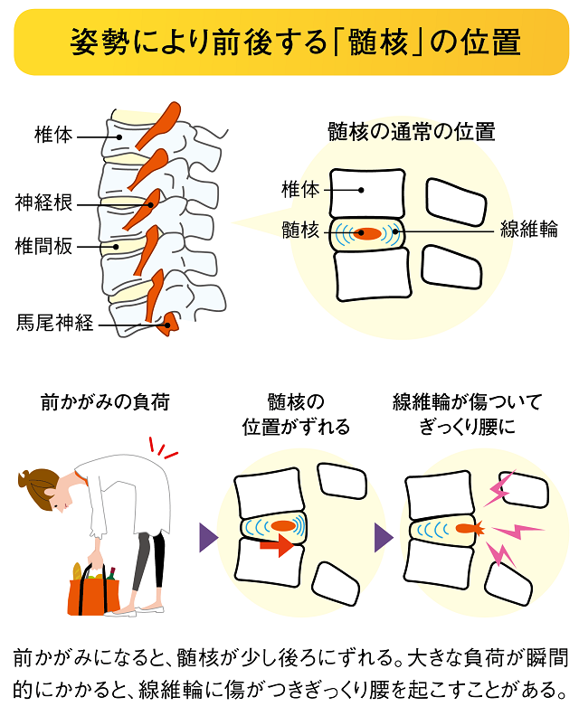 ぎっくり腰、どこが痛いタイプ？