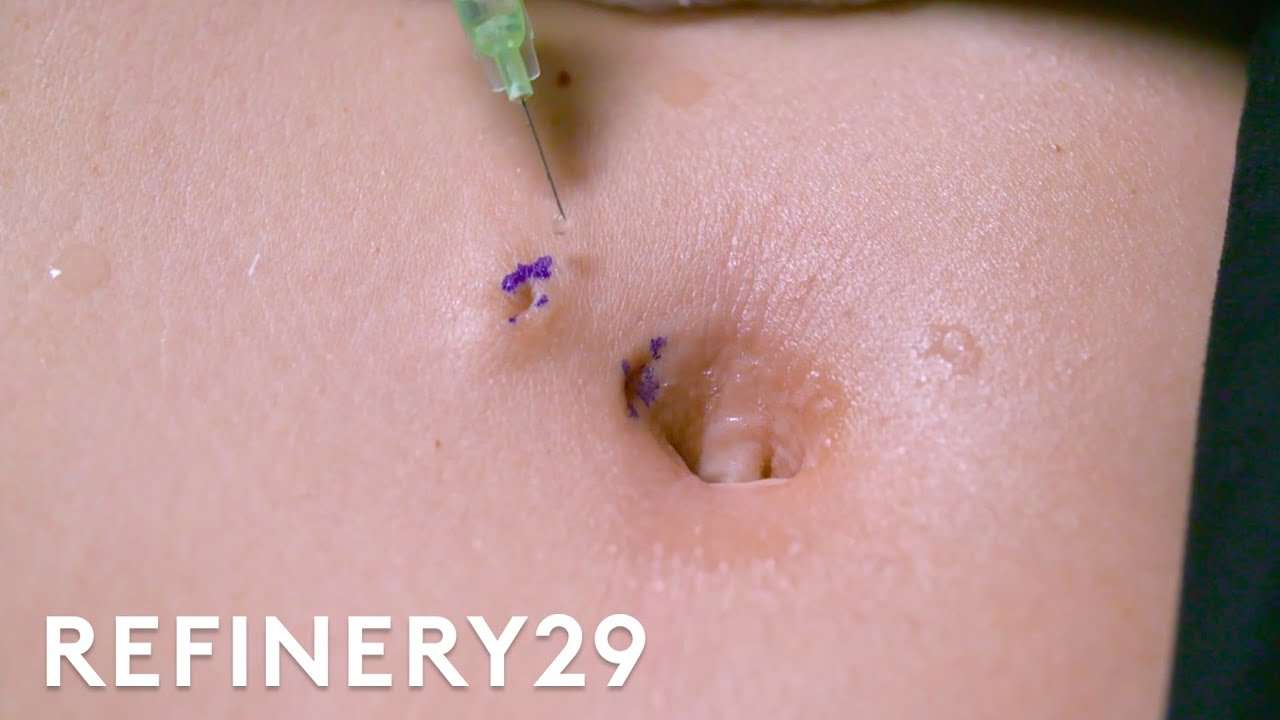 I Got The Belly Button Piercing Removal Surgery | Macro Beauty | Refinery29 - YouTube