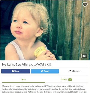 汗や涙でも皮膚に蕁麻疹や湿疹 「水アレルギー」に苦しむ1歳の米女児 - ライブドアニュース
