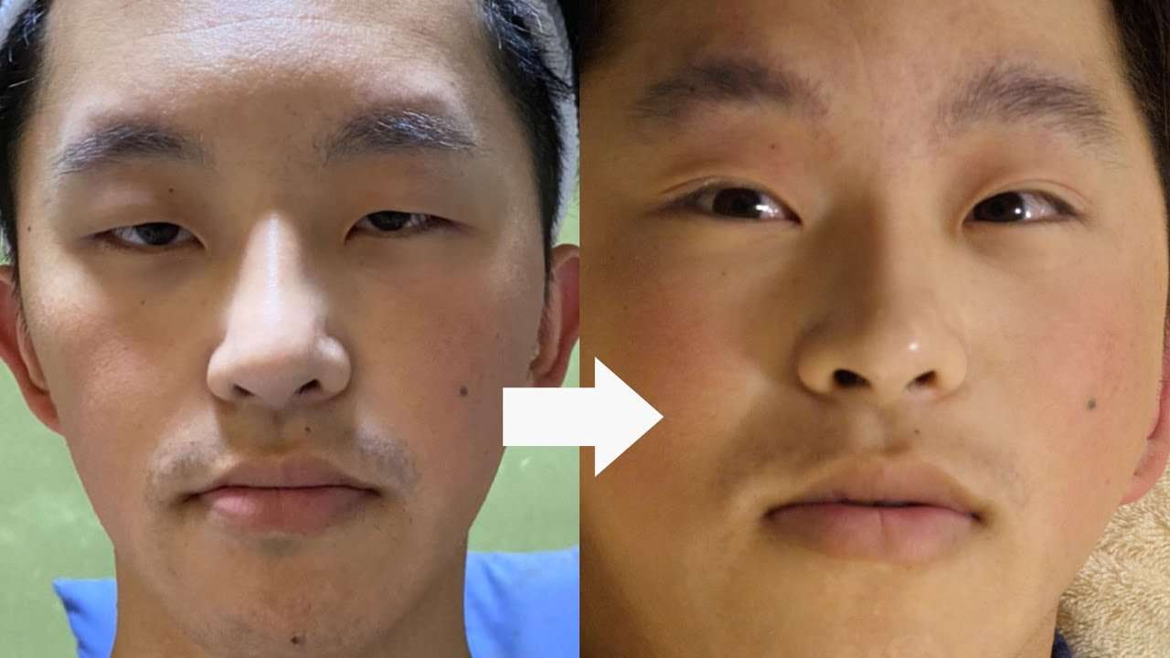 何してもダメだった一重の少年を整体で二重に - YouTube
