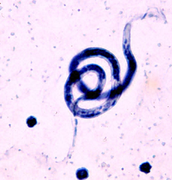 八丈小島のマレー糸状虫症 - Wikipedia