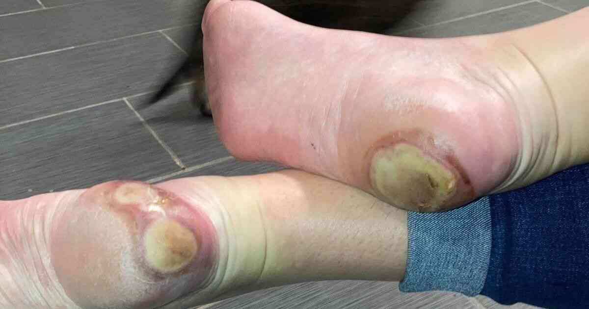 反ワクチン派「腫れた足」写真を拡散⇨新型コロナワクチンの副作用ではなかった | ハフポスト