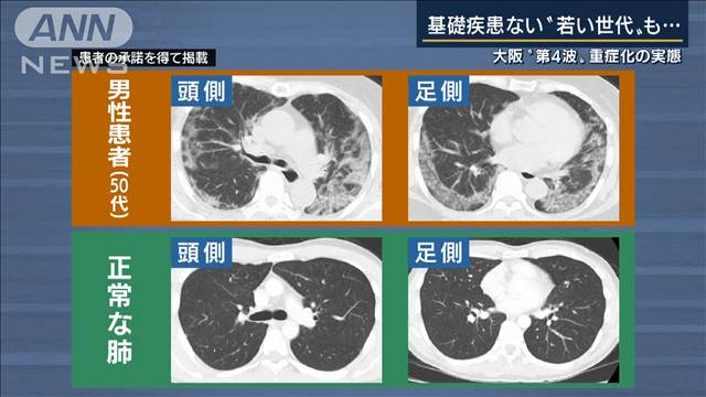 「今までと違う」 大阪“第4波”重症化の実態｜テレ朝news-テレビ朝日のニュースサイト