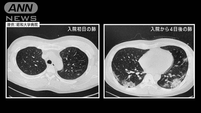 変異型「N501Y」基礎疾患ない20代患者も重症化｜テレ朝news-テレビ朝日のニュースサイト