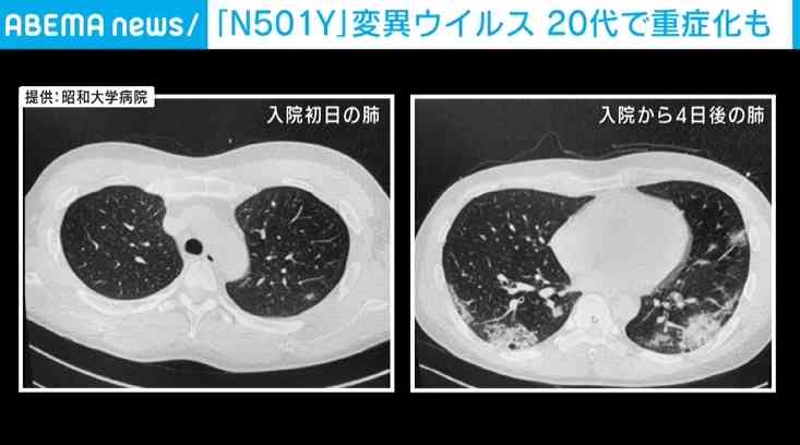 基礎疾患のない20代でも重症化 新型コロナ変異株「N501Y」の強さに起因か（ABEMA TIMES） - Yahoo!ニュース