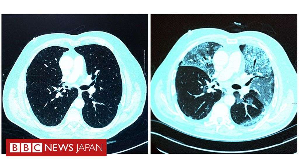 新型ウイルス重症者、肺に損傷残る恐れ　英医師ら警告 - BBCニュース