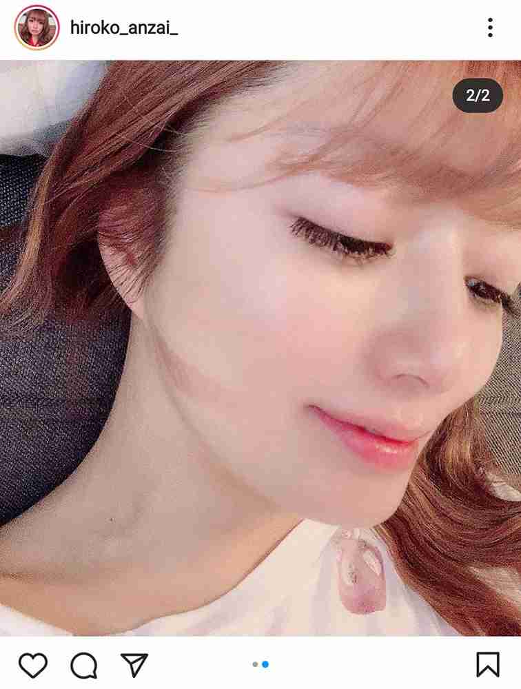 安西ひろこ 痛々しい…髪のコテで火傷した顔写真公開「残りませんように」