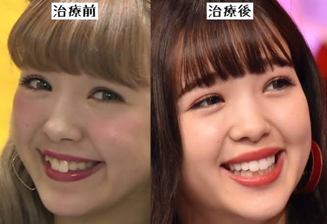 歯の部分矯正について