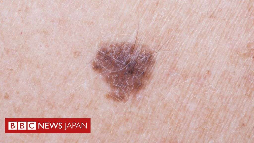 腕のほくろの数で皮膚がんリスクを測定＝英研究 - BBCニュース