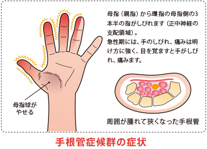 手根管症候群の方