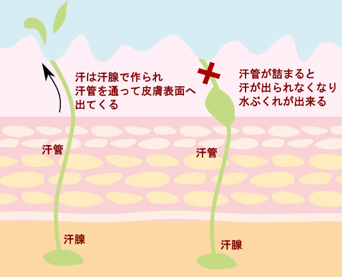 汗疱(異汗性湿疹)でお悩みの方！