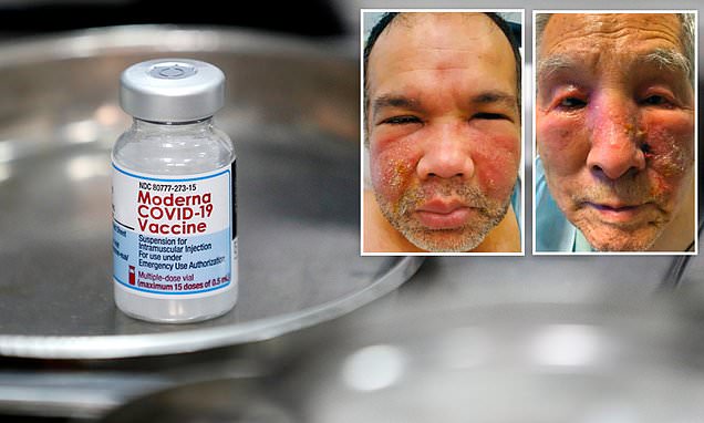 Two men developed PUS-FILLED bumps on their faces in rare side effect from Moderna COVID-19 vaccine  | Daily Mail Online
