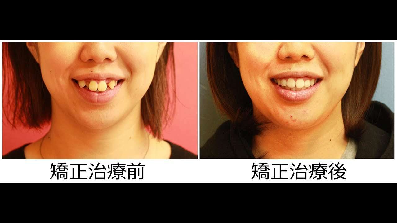 23歳 女性  「八重歯を治したい」 治療期間18か月（ 重度の叢生 抜歯 ） - YouTube